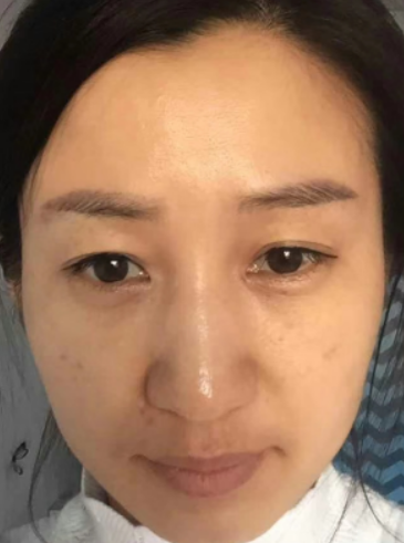 去眼袋手术