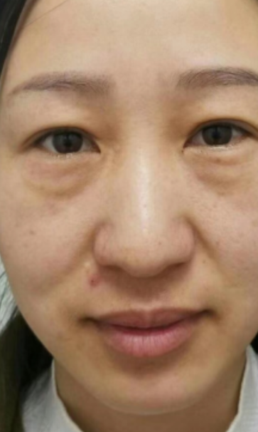去眼袋手术