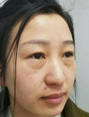 去眼袋手术