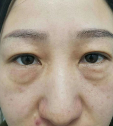 去眼袋手术