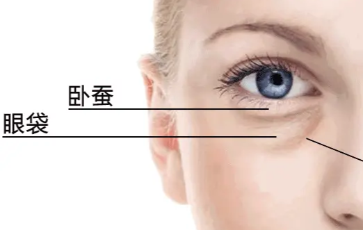 去眼袋手术