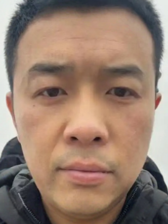去眼袋手术