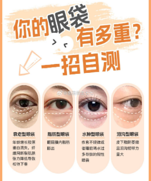 去眼袋手术