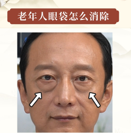 去眼袋手术