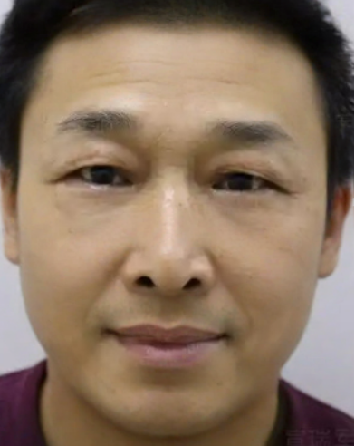 去眼袋手术