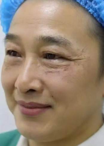去眼袋手术