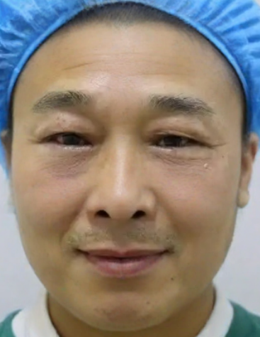去眼袋手术