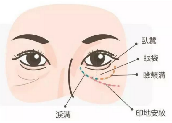 去眼袋手术