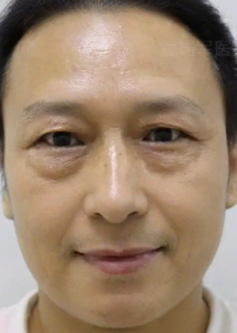 去眼袋手术