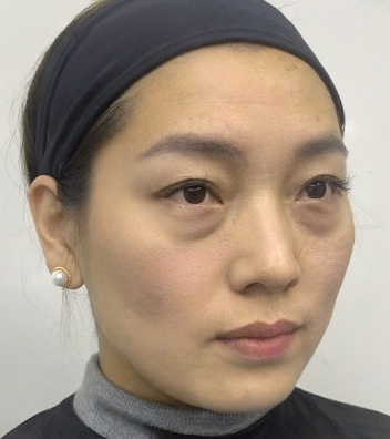 去眼袋手术