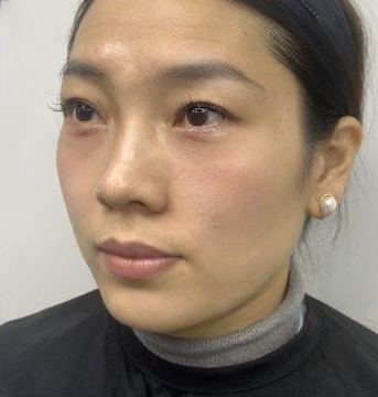 去眼袋手术
