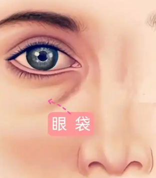 去眼袋手术