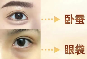 去眼袋手术