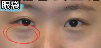 去眼袋手术