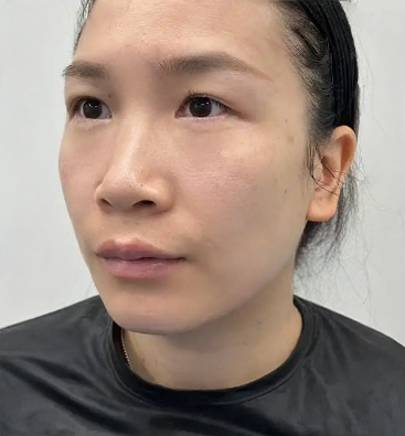 去眼袋手术