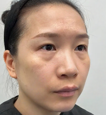 去眼袋手术