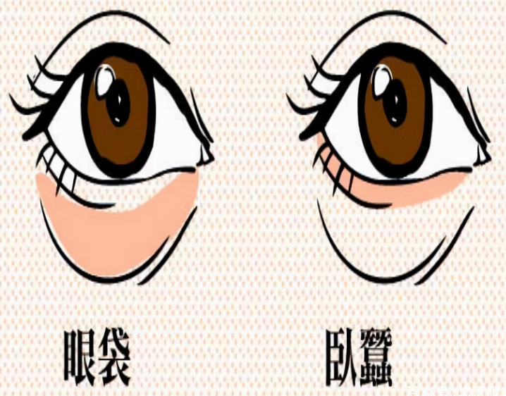 去眼袋手术