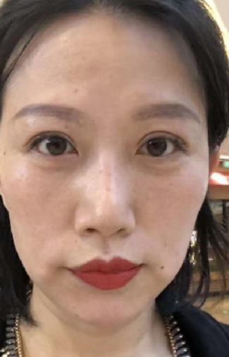去眼袋手术