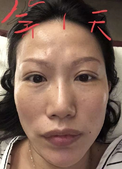 去眼袋手术