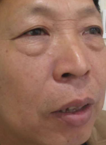 去眼袋手术