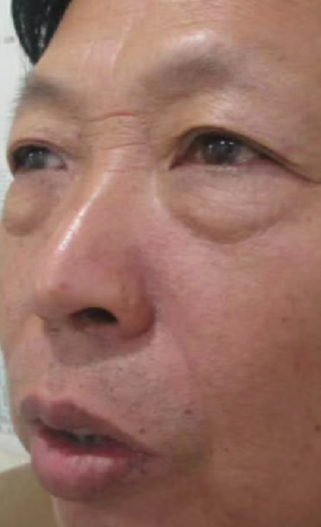 去眼袋手术