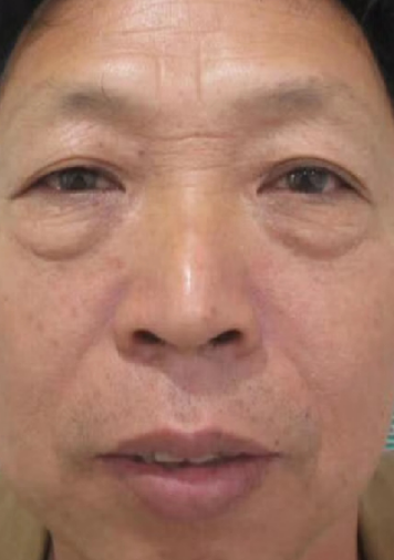 去眼袋手术