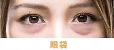 眼袋