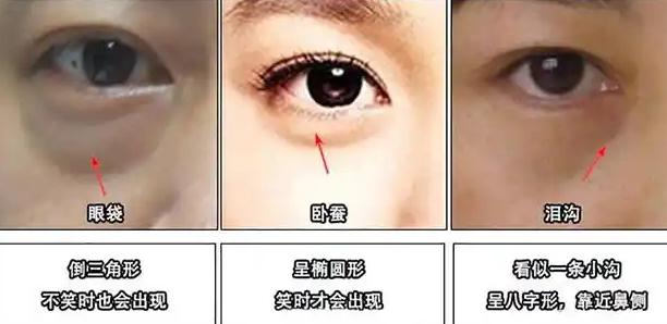 眼袋
