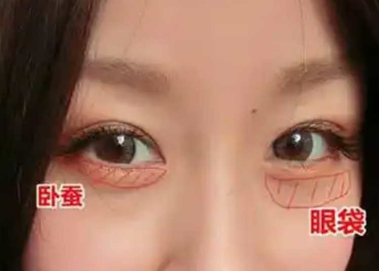 眼袋