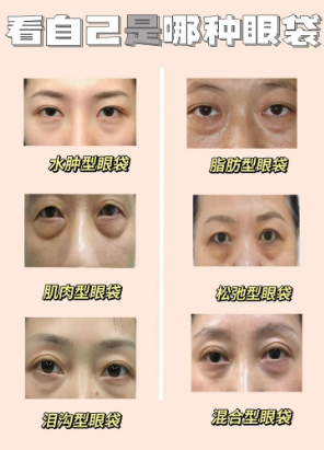 眼袋
