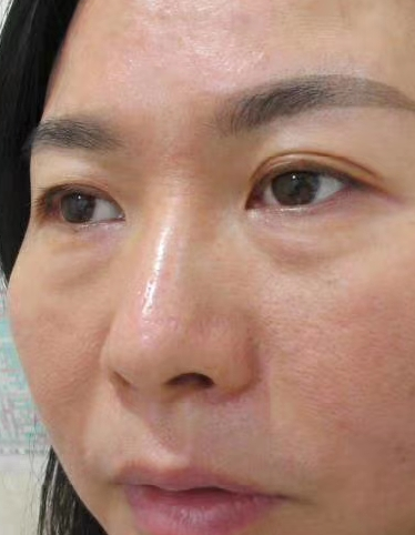 去眼袋手术