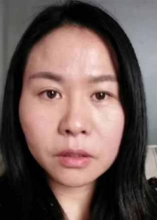 去眼袋手术