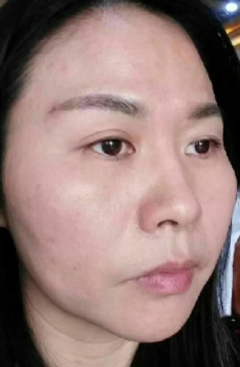 去眼袋手术