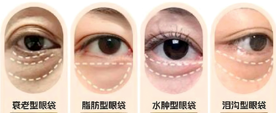 去眼袋手术