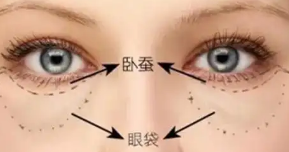 去眼袋手术