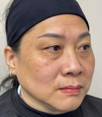 去眼袋手术