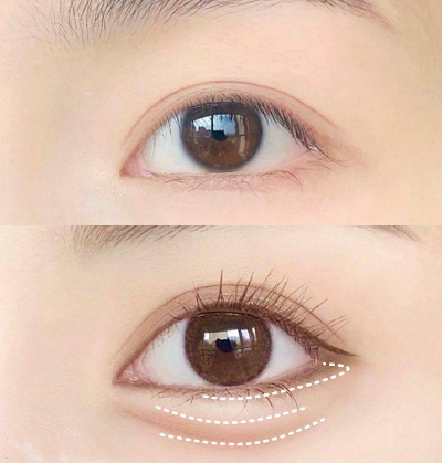 眼袋