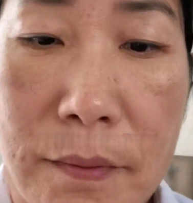 去眼袋手术