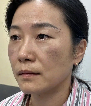 去眼袋手术