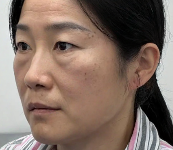 去眼袋手术