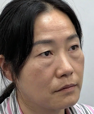 去眼袋手术