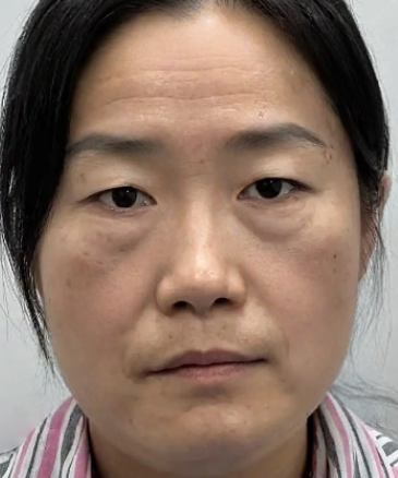 去眼袋手术