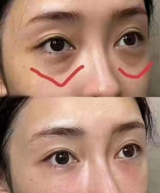 眼袋