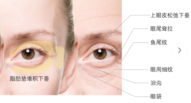 眼袋