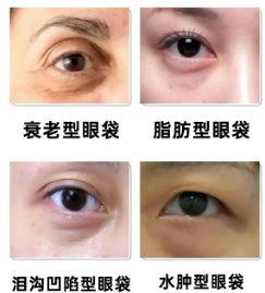 眼袋
