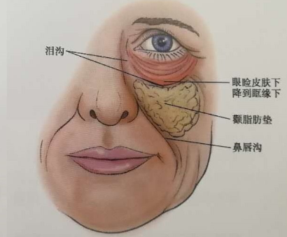 眼袋