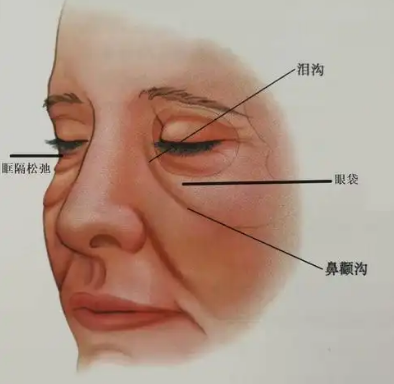 眼袋