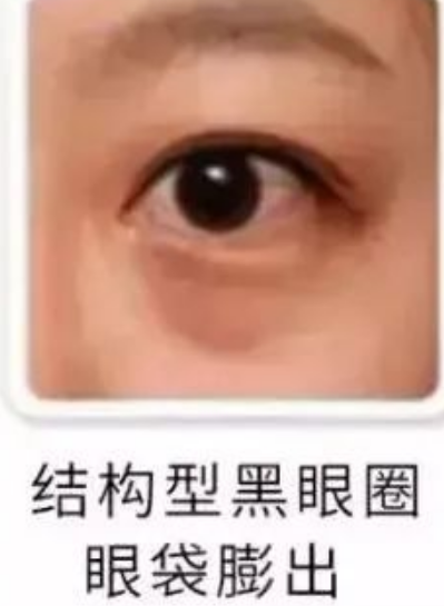眼袋