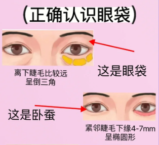 去眼袋手术
