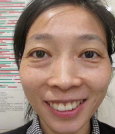 去眼袋手术